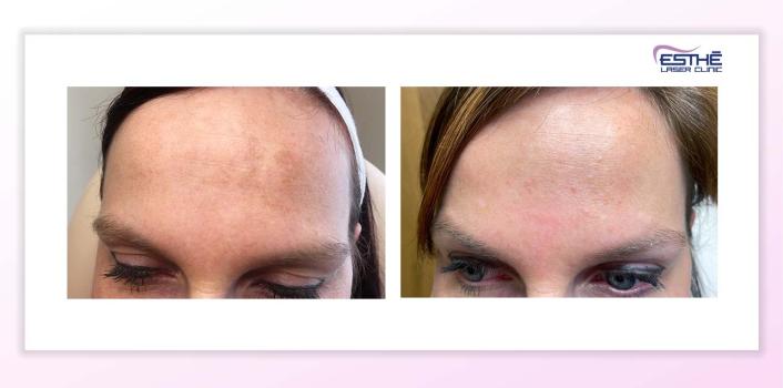 Melasma - Esthé Laser Clinic