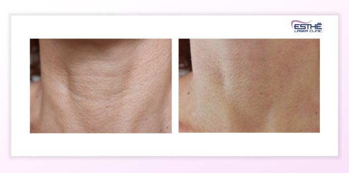 Microneedling - Esthé Laser Clinic